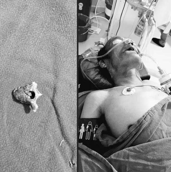 प्रतिष्ठानमा वृद्धको घाटिमा अड्किएको खसिको हड्डि अप्रेसन गरेर सफलतापुर्बक निकालियो